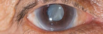 A photo of a human eye - catarct
