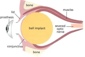 Diagram of an implant in the eye socket