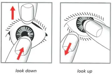 Diagram showing the fitting of a Prosthetic Eye