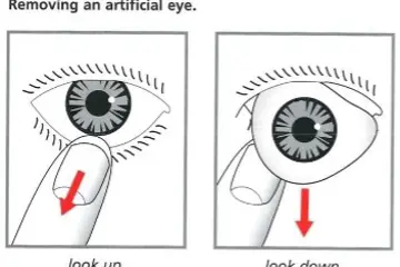 Diagram showing how to remove an artificial eye