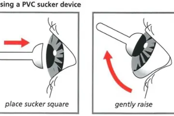 Diagram showing how to remove a prosthetic eye using a silicone extractor