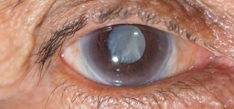 What To Expect When You Have Treatment For Cataracts photo