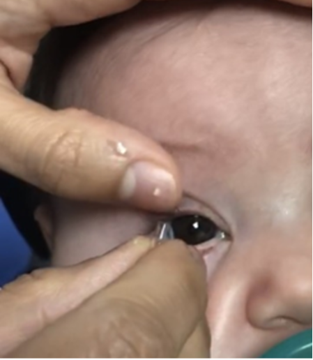 Placing a contact lens on a baby's eye