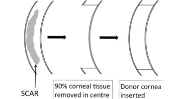 Corneal transplantation: deep anterior lamellar keratoplasty (DALK ...