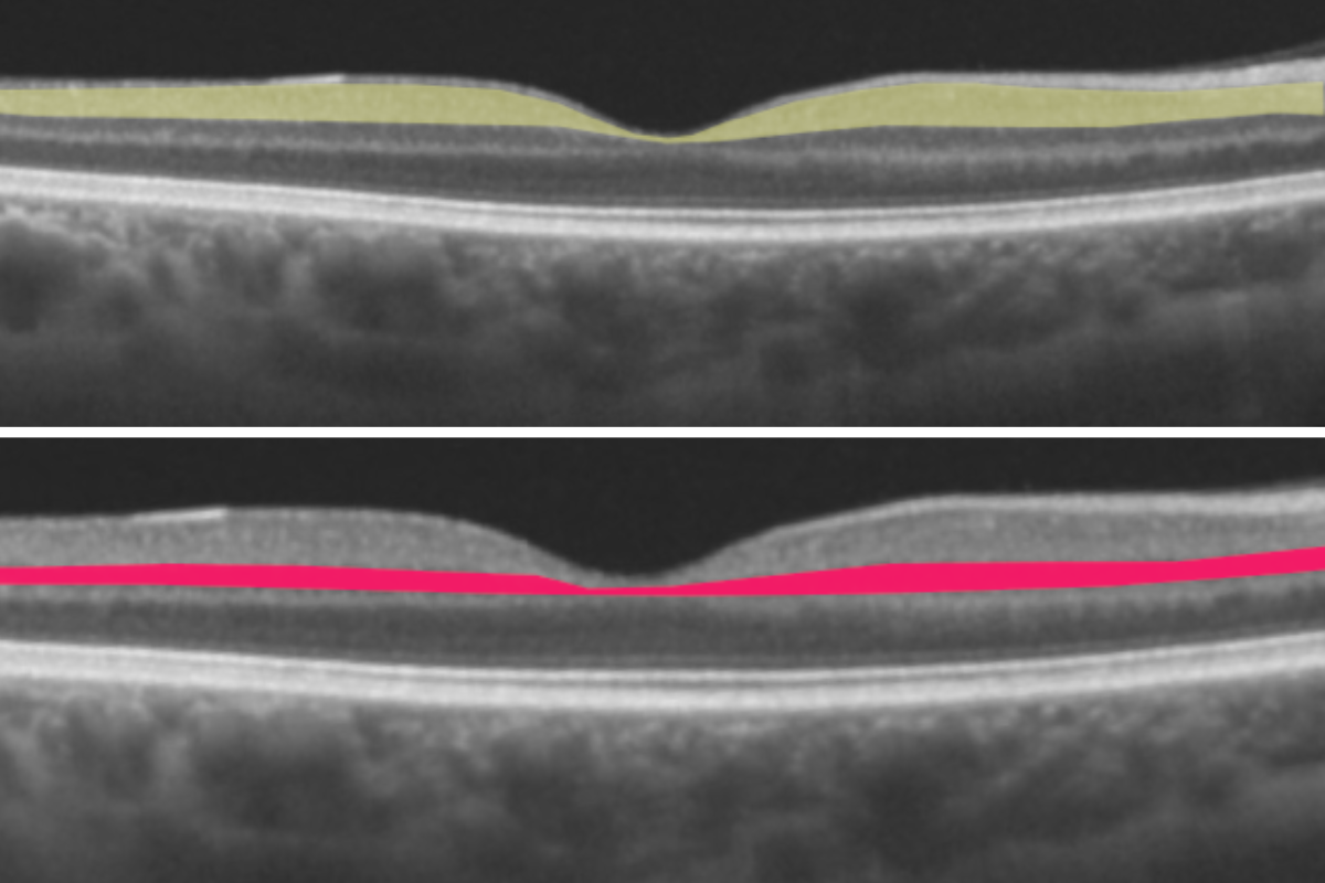 image of Thinning macular layers associated with AF