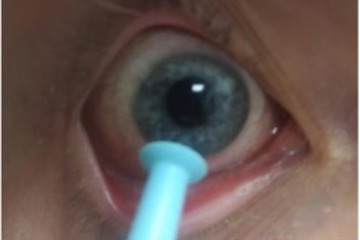 Contact Lens Removal With Blue Device