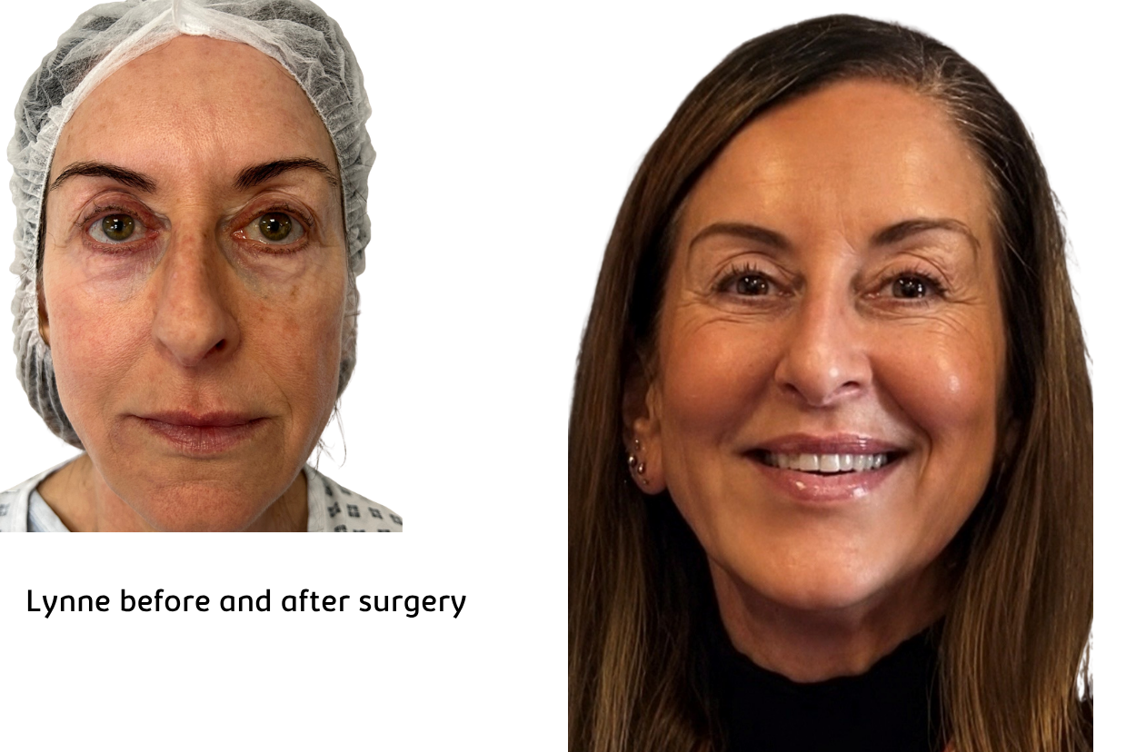 Lynne-before and after her surgery