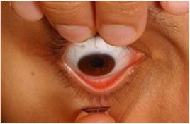 Photo of inserting Rigid Gas Permeable Contact Lenses