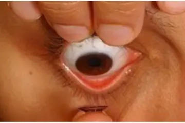 Photo of inserting Rigid Gas Permeable Contact Lenses