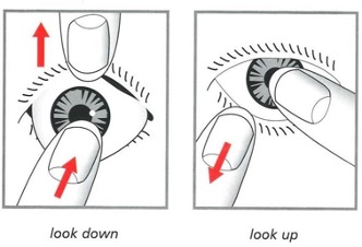 Diagram showing the fitting of a Prosthetic Eye
