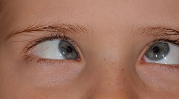 Child's eyes affected by strabismus