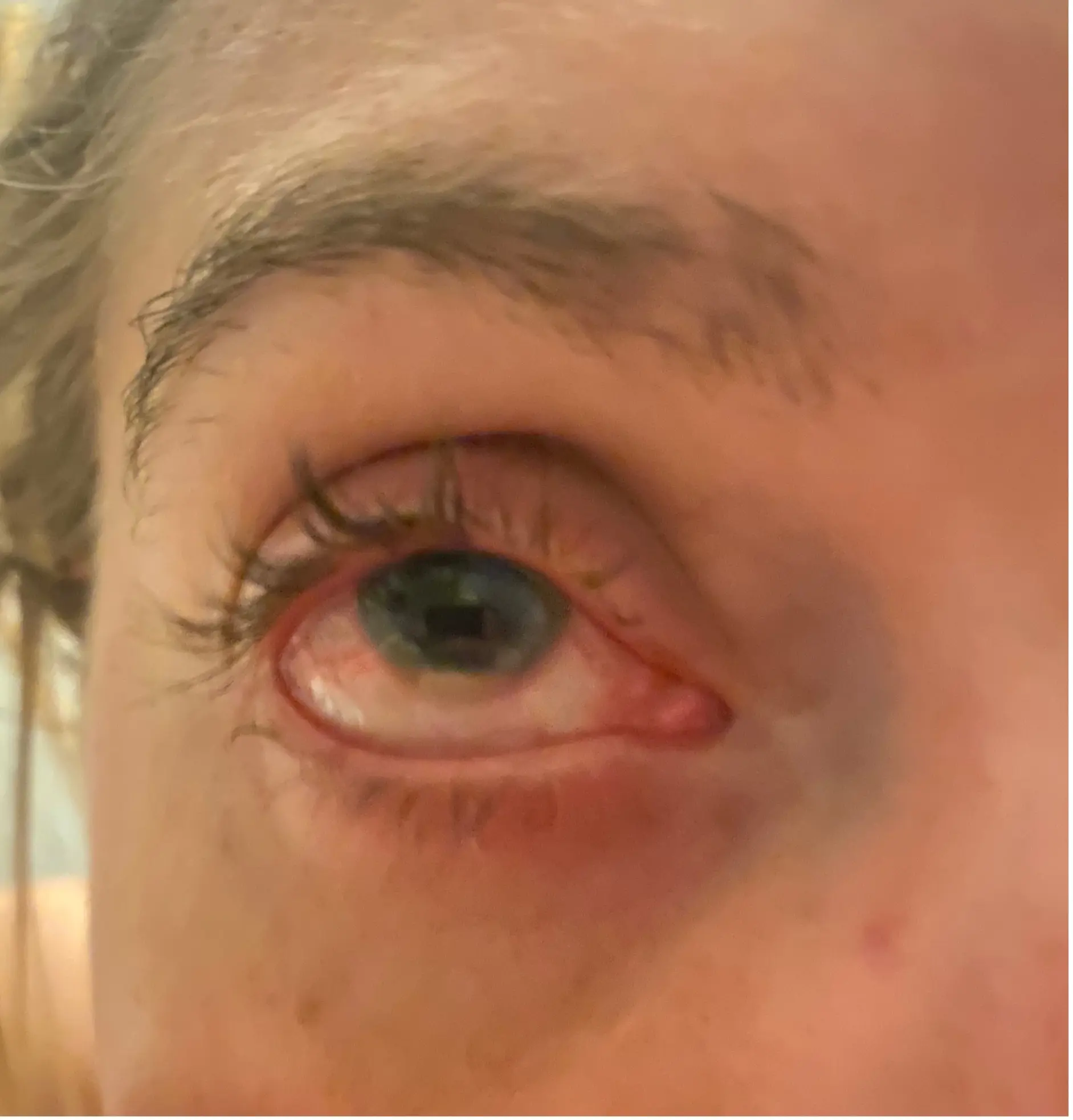 Close up of an eye with Baduveitis
