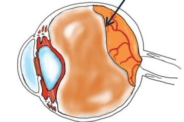 Posterior vitreous detachment 