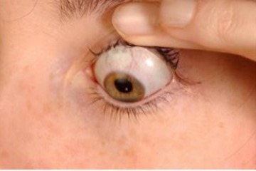 Scleral Contact Lenses removal