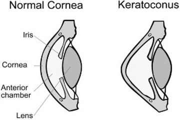 Keratoconus Cornea diagram