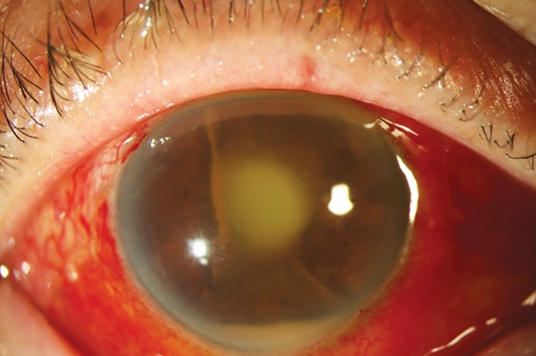 Close-up of an eye with a red sclera and cloudy pupil