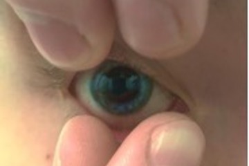Removal Of Contact Lens