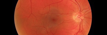 Cascader Retinal Image