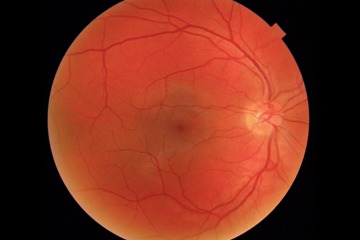 Cascader Retinal Image